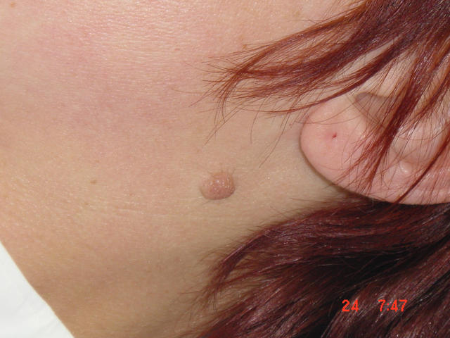 BENIGN SKIN LESIONS, NEVI, CYSTS - Naevus, dermal