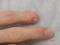 FACTICIAL LESIONS - Post-traumatic remainder of a nail