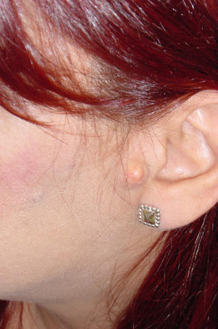BENIGN SKIN LESIONS, NEVI, CYSTS - Pro-auricular cyst