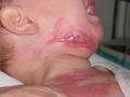FACTICIAL LESIONS - Post-burn scars