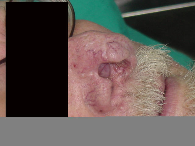 MALIGNANT LESIONS - Basal Cell Carcinoma