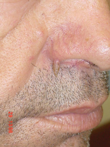 PREMALIGNANT LESIONS - Horn PREMALIGNANT LESIONS - Horn