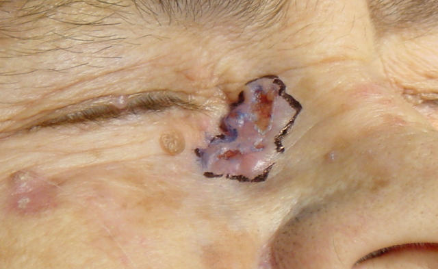 MALIGNANT LESIONS - Basal Cell Carcinoma, cystic