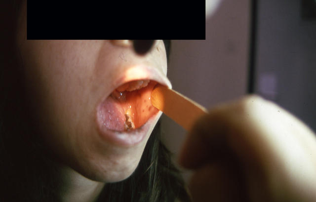 PIGMENTATION DISORDERS - Peutz - Jeghers syndrome PIGMENTATION DISORDERS - Peutz - Jeghers syndrome