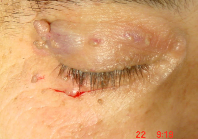 BENIGN SKIN LESIONS, NEVI, CYSTS - Skin tags