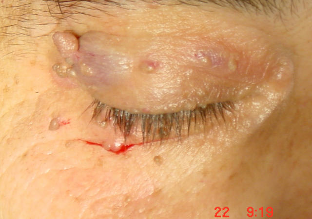BENIGN SKIN LESIONS, NEVI, CYSTS - Skin tags BENIGN SKIN LESIONS, NEVI, CYSTS - Skin tags