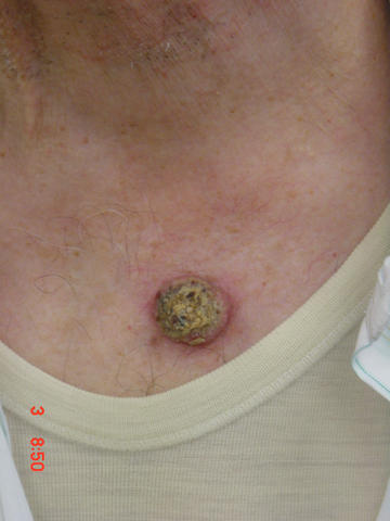 MALIGNANT LESIONS - Keratoacanthoma