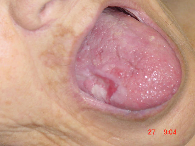 MALIGNANT LESIONS - Squamous Cell Carcinoma (SCC) of the tongue