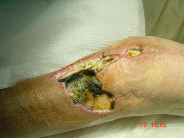 VARIOUS or of UNKNOWN ETIOLOGY DISEASES - Gangrene afte total arthroplasty VARIOUS or of UNKNOWN ETIOLOGY DISEASES - Gangrene afte total arthroplasty