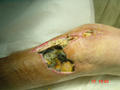 VARIOUS or of UNKNOWN ETIOLOGY DISEASES - Gangrene afte total arthroplasty