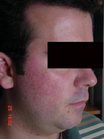 DISEASES OF THE SEBACEOUS GLANDS - Rosacea DISEASES OF THE SEBACEOUS GLANDS - Rosacea