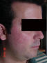 DISEASES OF THE SEBACEOUS GLANDS - Rosacea