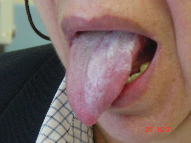 MUCOSAL LESIONS - Leukoplakia