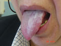 MUCOSAL LESIONS - Leukoplakia