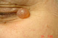 BENIGN SKIN LESIONS, NEVI, CYSTS - 