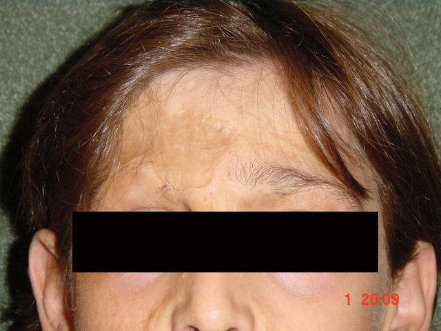 FACTICIAL LESIONS - Post-burn loss of eyebrow FACTICIAL LESIONS - Post-burn loss of eyebrow