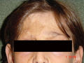 FACTICIAL LESIONS - Post-burn loss of eyebrow