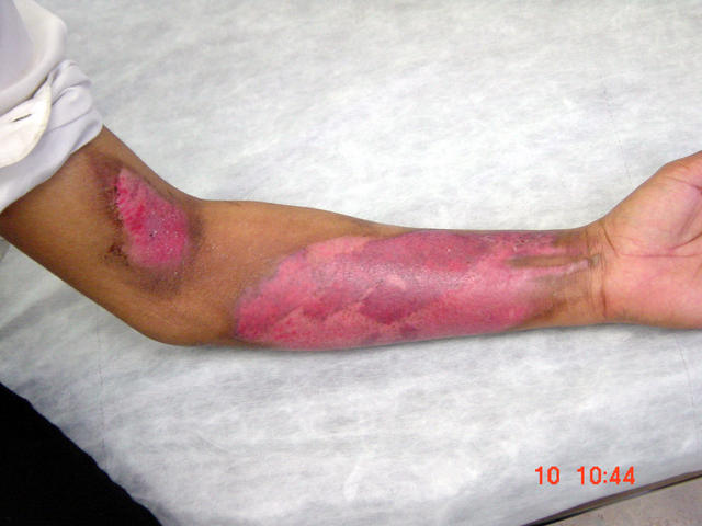 MALIGNANT LESIONS - Burn MALIGNANT LESIONS - Burn