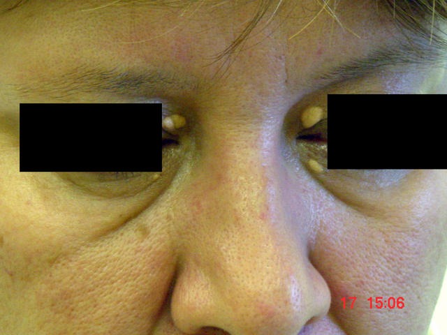 METABOLIC DISEASE, NUTRITION - Xanthelasma METABOLIC DISEASE, NUTRITION - Xanthelasma