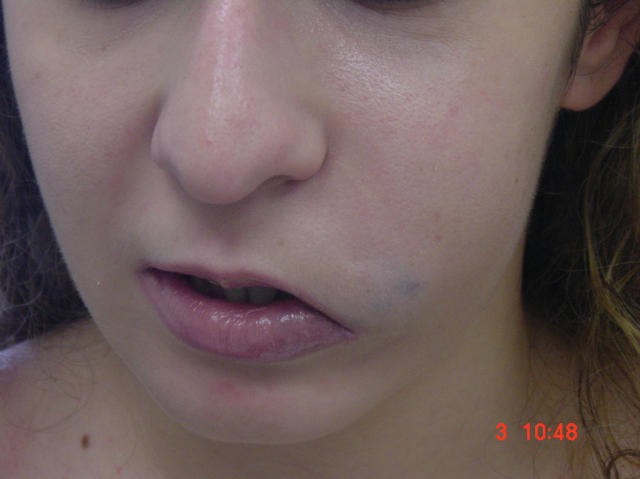 DISEASE OF THE BLOOD AND THE VESSELS – PURPURAS - Hemangioma, cavernous DISEASE OF THE BLOOD AND THE VESSELS – PURPURAS - Hemangioma, cavernous