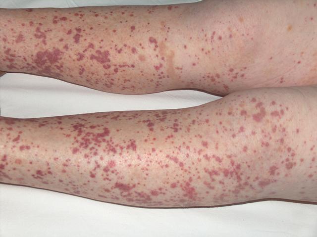 DRUG ERUPTIONS - Drug eruption DRUG ERUPTIONS - Drug eruption