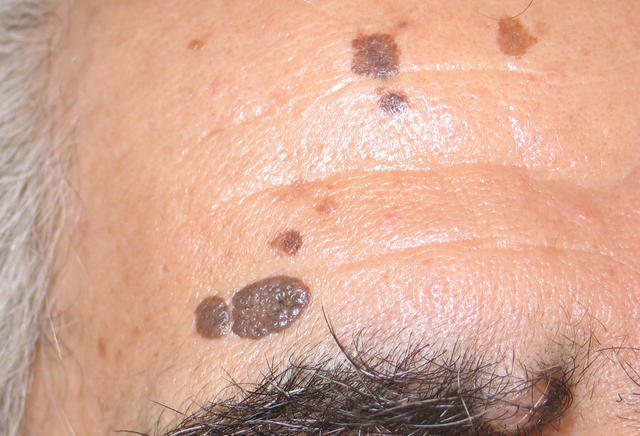 BENIGN SKIN LESIONS, NEVI, CYSTS - Seborrheic keratosis