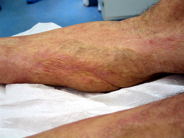 FACTICIAL LESIONS - Post-burn scars FACTICIAL LESIONS - Post-burn scars
