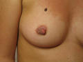 DERMATITIS - EKZEMA - Eczema of the nipple