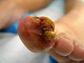 NAIL DISEASES - Ingrowing nail