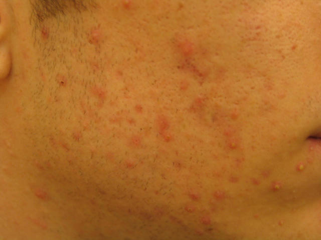 DISEASES OF THE SEBACEOUS GLANDS - Acne, inflammatory of the face DISEASES OF THE SEBACEOUS GLANDS - Acne, inflammatory of the face