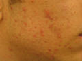 DISEASES OF THE SEBACEOUS GLANDS - Acne, inflammatory of the face