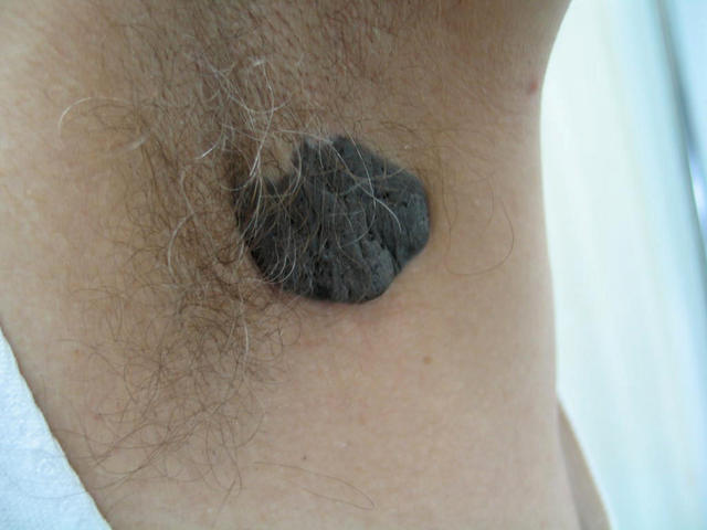 BENIGN SKIN LESIONS, NEVI, CYSTS - Sebaceous naevus BENIGN SKIN LESIONS, NEVI, CYSTS - Sebaceous naevus