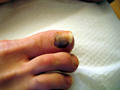 MALIGNANT LESIONS - Acral melanoma, nail