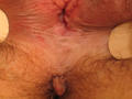 LICHEN - Lichen sclerosus et atrophicus of female genitalia