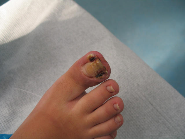 NAIL DISEASES - Ingrowing nail