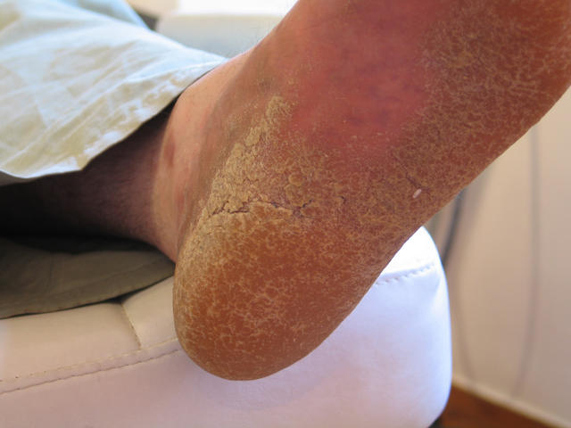 PSORIASIS - Psoriatic plantar keratodema