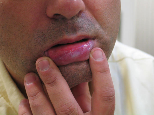 MUCOSAL LESIONS - Leukoplakia MUCOSAL LESIONS - Leukoplakia