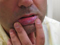 MUCOSAL LESIONS - Leukoplakia