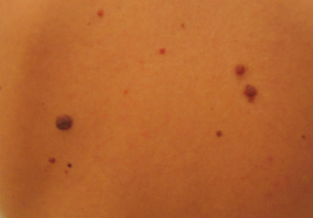 BENIGN SKIN LESIONS, NEVI, CYSTS - Dysplastic naevus BENIGN SKIN LESIONS, NEVI, CYSTS - Dysplastic naevus