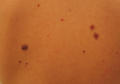 BENIGN SKIN LESIONS, NEVI, CYSTS - Dysplastic naevus