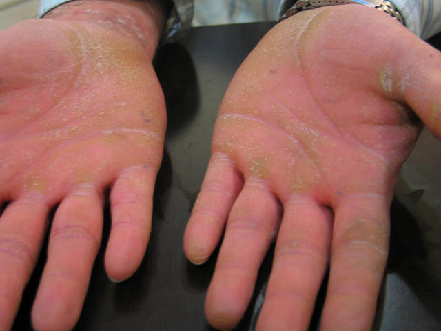 PSORIASIS - Psoriasis PSORIASIS - Psoriasis