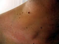 BENIGN SKIN LESIONS, NEVI, CYSTS - Skin tags