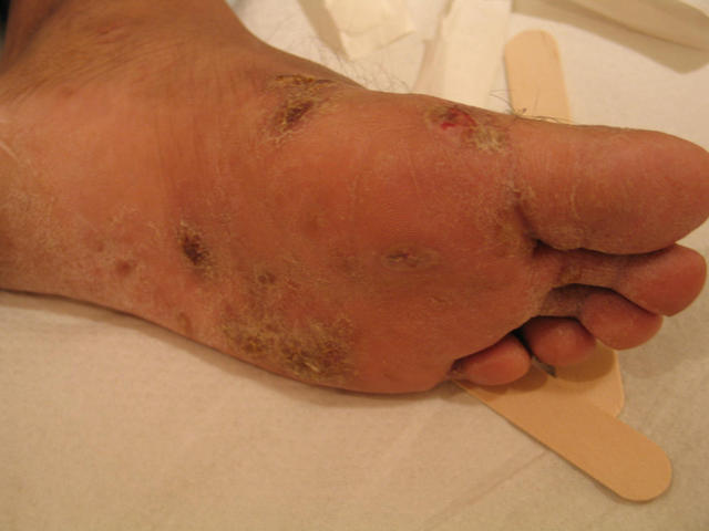 BACTERIAL INFECTIONS - Impetigo