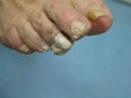 NAIL DISEASES - Onychomycosis