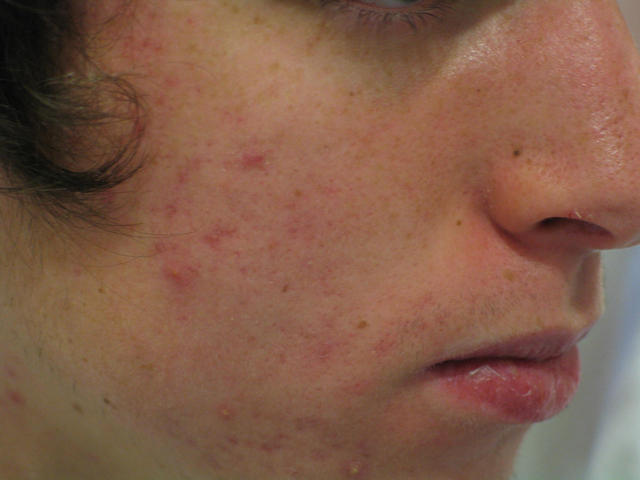 DISEASES OF THE SEBACEOUS GLANDS - Acne, inflammatory of the face DISEASES OF THE SEBACEOUS GLANDS - Acne, inflammatory of the face