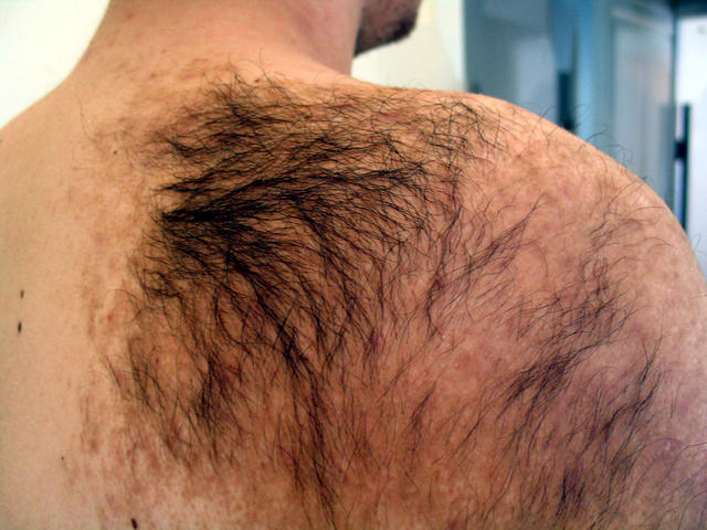 Hairy Naevus 42