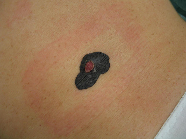 MALIGNANT LESIONS - Melanoma