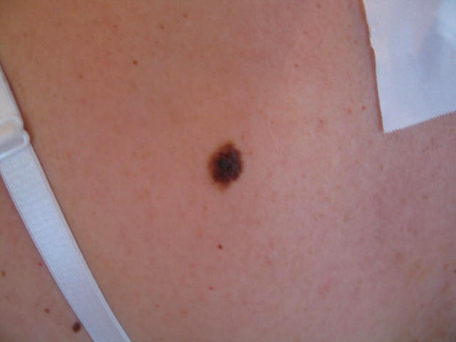 BENIGN SKIN LESIONS, NEVI, CYSTS - Dysplastic naevus BENIGN SKIN LESIONS, NEVI, CYSTS - Dysplastic naevus