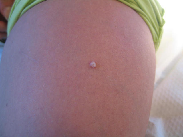 VIRAL INFECTIONS - Warts VIRAL INFECTIONS - Warts