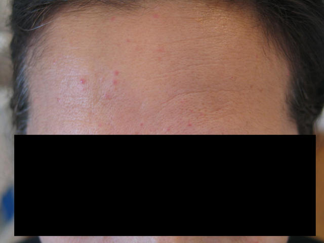 DRUG ERUPTIONS - Drug eruption DRUG ERUPTIONS - Drug eruption